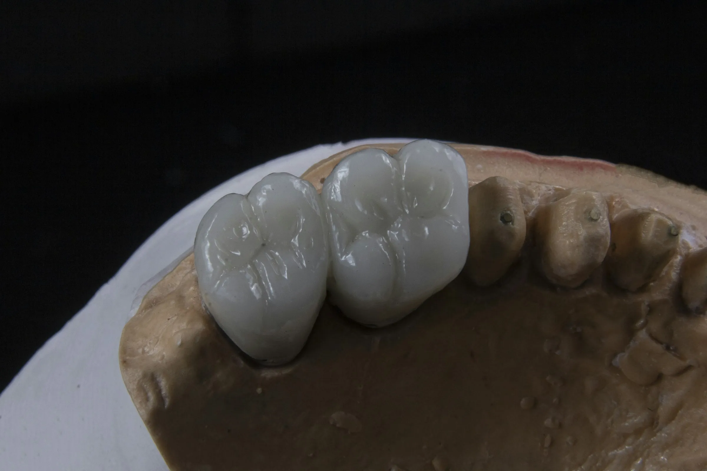 Porselen Dolgu (İnley / Onley) — MSG Dent